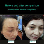 Stylo de soin beauté laser plasma portable à picoseconde (élimination tatouage, tache de rousseur, grain de beauté), lumière bleue USB / lumière rouge USB