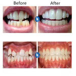 Appareil Orthodontique Simulation en Silicone Appareils Anti-Molaires pour la Nuit, Première étape, Deuxième étape, Troisième étape