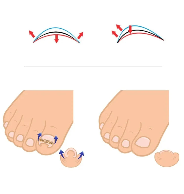 Orthèse d'ongle 12 en 1 avec ongles incarnés