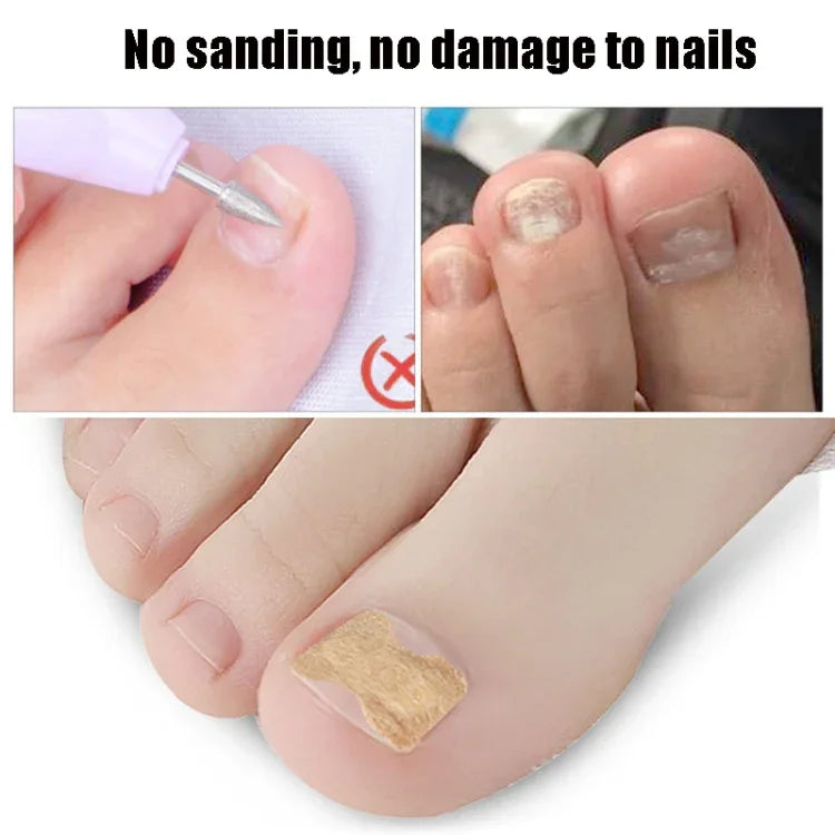 10 PCS Correcteur Orthopédique D'ongles Sans Colle, Bâtonnet Rainure Ongle Orteil Incrustation Correcteur, Fond Transparent, Fond Blanc, Fond Bleu
