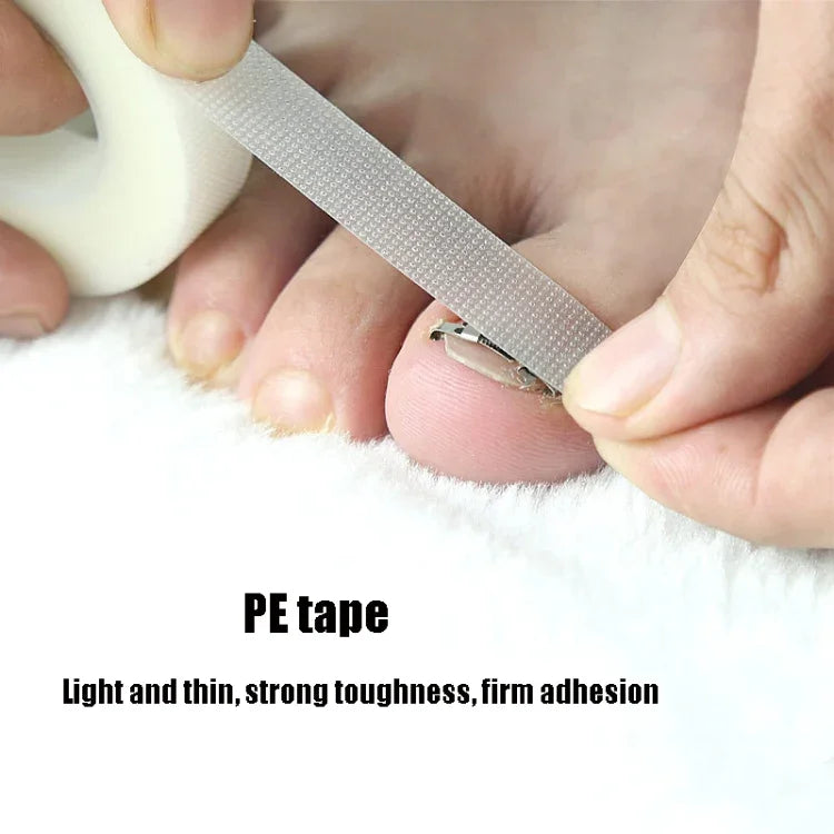 Correcteur d'ongles incarnés orthopédiques à boucle, boucle d'ongle positive n° 36, boucle d'ongle positive n° 38, boucle d'ongle positive n° 40, boucle d'ongle positive n° 42, boucle d'ongle positive n° 44, kit n° 36, kit n° 38, kit n° 40, kit n° 42