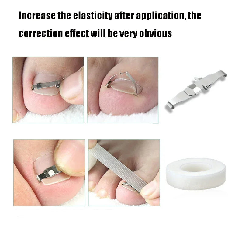 Correcteur d'ongles incarnés orthopédiques à boucle, boucle d'ongle positive n° 36, boucle d'ongle positive n° 38, boucle d'ongle positive n° 40, boucle d'ongle positive n° 42, boucle d'ongle positive n° 44, kit n° 36, kit n° 38, kit n° 40, kit n° 42