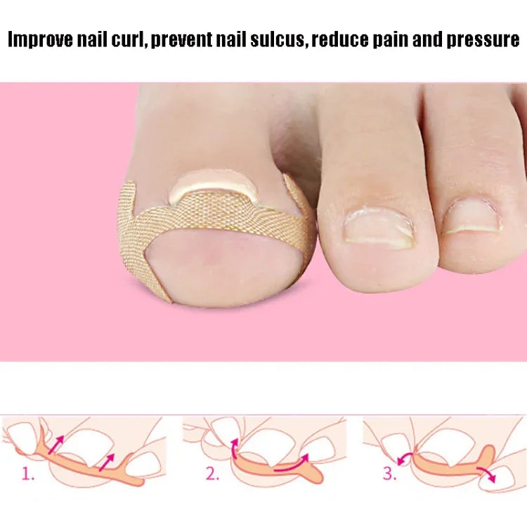 10 jeux de bandes de correction pour ongles incarnés Bande de sillon d'ongle d'orteil