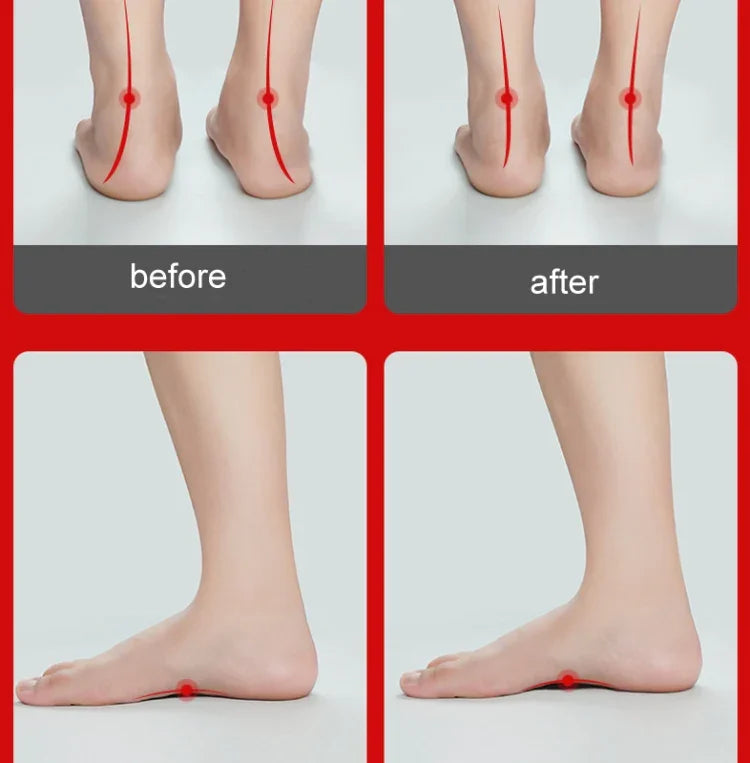 Semelles orthopédiques pour pieds plats avec soutien de la voûte plantaire, orthèses pour pieds valgus adultes et enfants, L (Blanc)