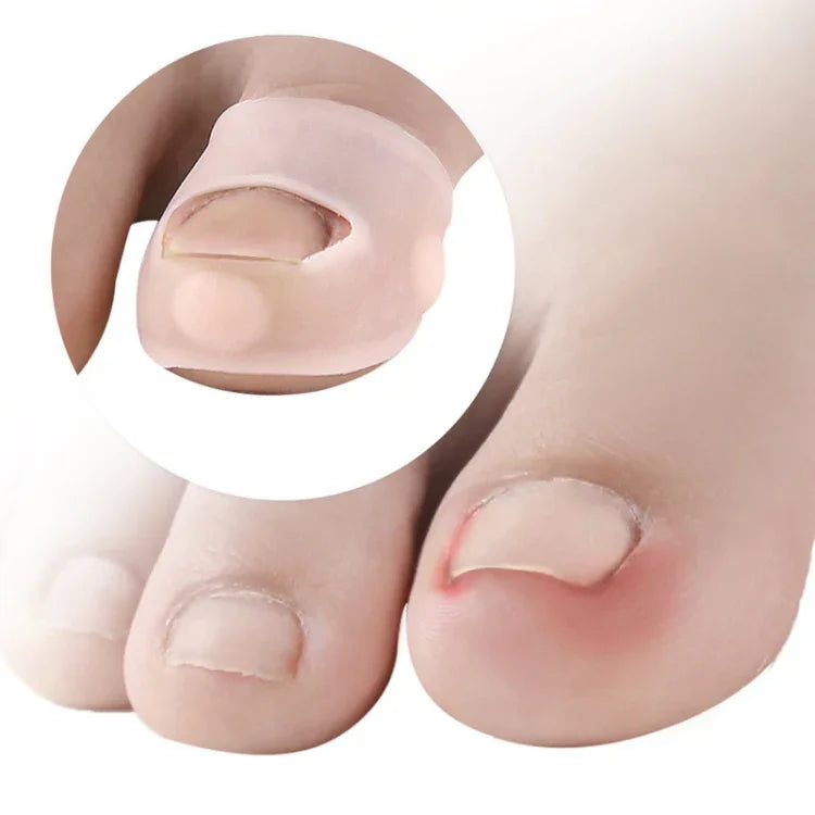 Ongles incarnés : empêche les ongles de s'enfoncer dans la chair, correction d'ongles, taille unique