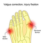 1 paire de chaussures portables, correcteur d'hallux valgus pour gros orteil, séparateur d'orteils confortable, S, L